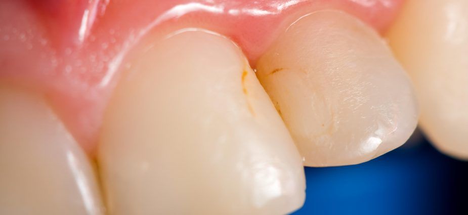 tooth-discoloration-925x425.jpg