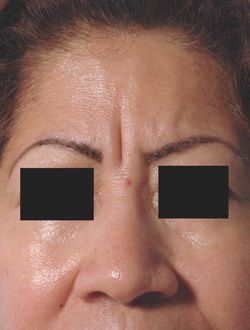 Botox-Glabella-frown-line-before.jpg