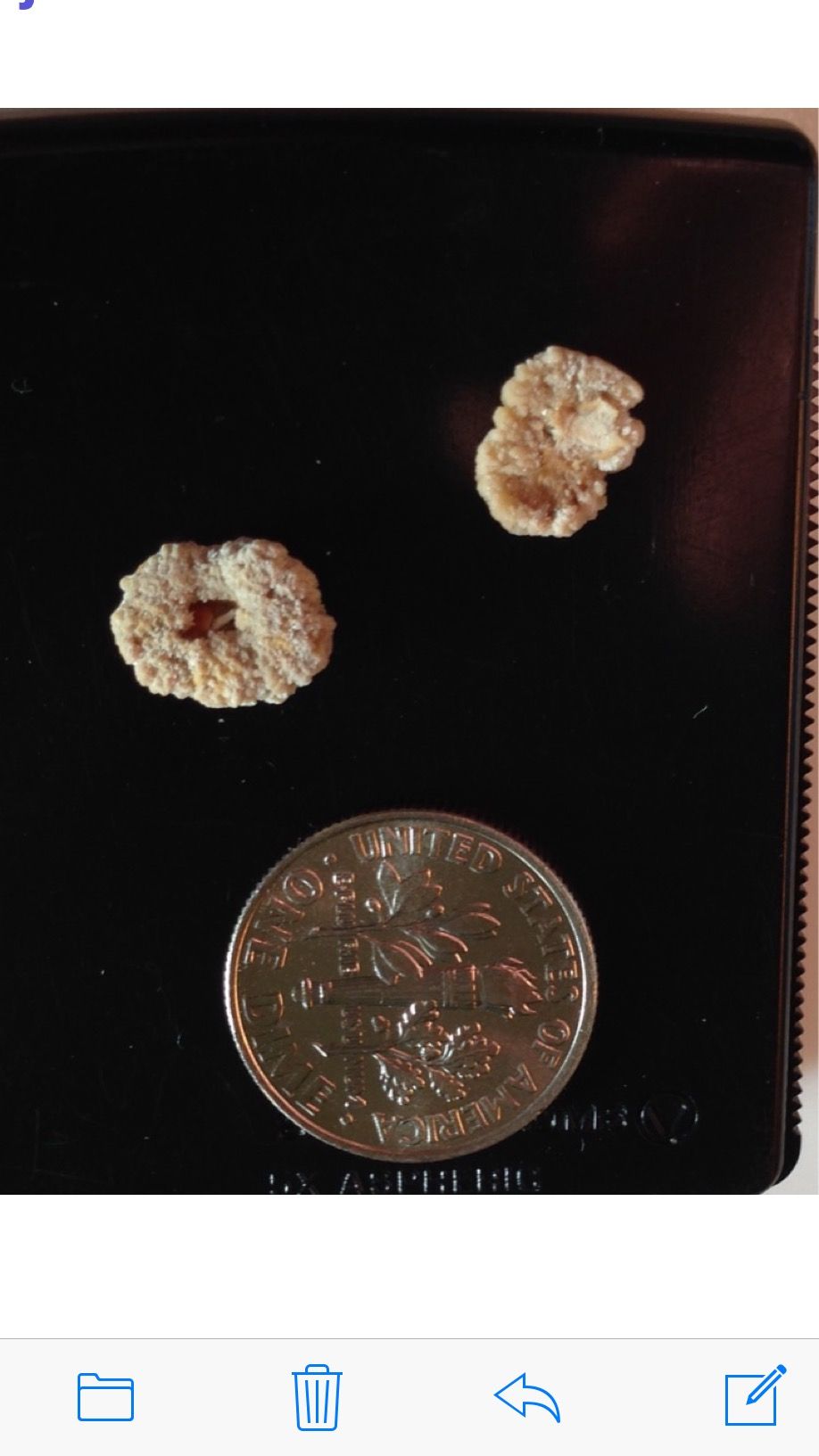 kidney stones